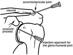 Frozen Shoulder